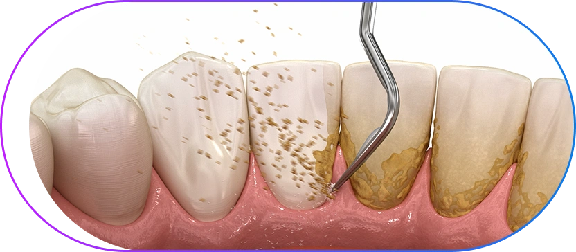 Periodontal cleaning procedure showing plaque removal and gum treatment