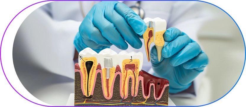 Cross-section dental model showing tooth anatomy and dental treatment procedures
