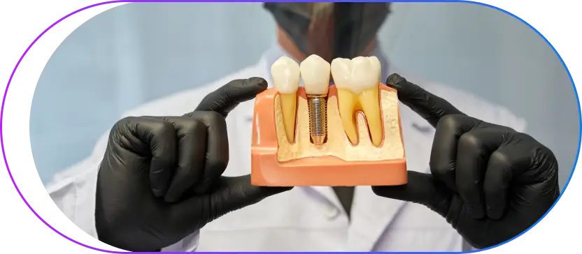 Dental implant model showing implant placement in jaw bone structure
