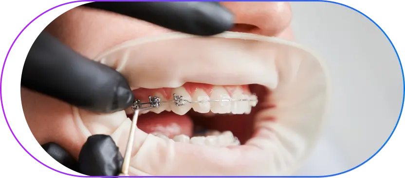 Close-up of orthodontic braces being adjusted with dental instruments