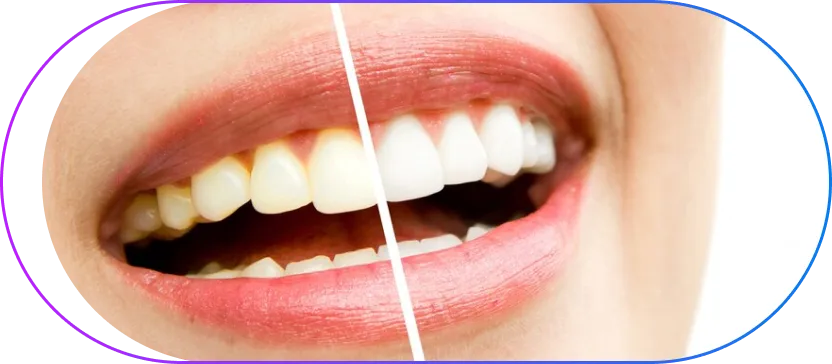 Before and after teeth whitening treatment showing dramatic improvement in tooth color